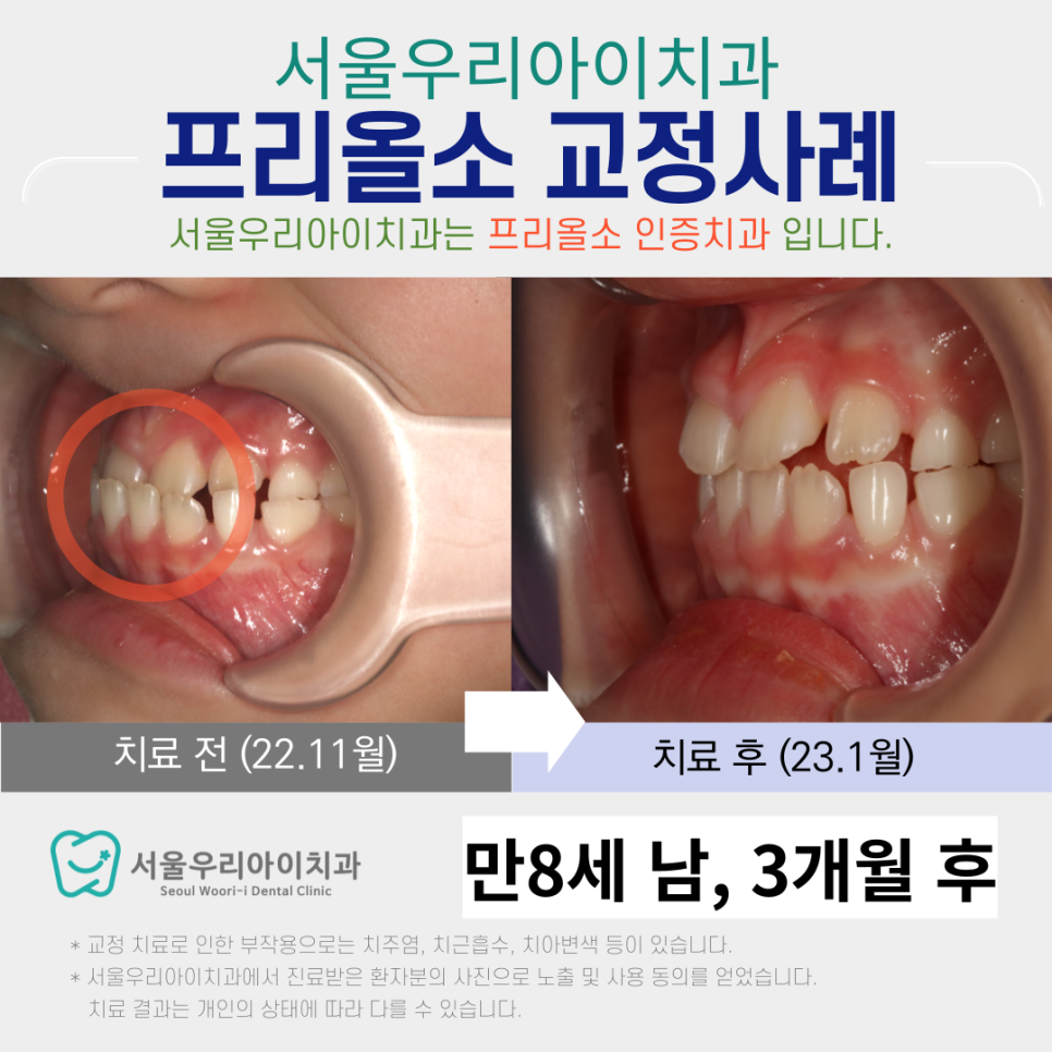 광주 소아치과 광주아이교정치과에서 프리올소 교정장치를 사용하는 법?
