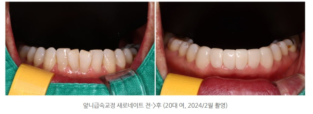 광주 아랫니 급속교정 아래치아 라미네이트 잘하는 곳에서 전문의 진료로