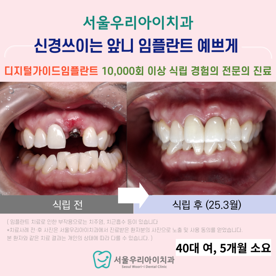 수완지구 임플란트 치과 앞니 임플란트 예쁘게 하는 곳 찾는다면