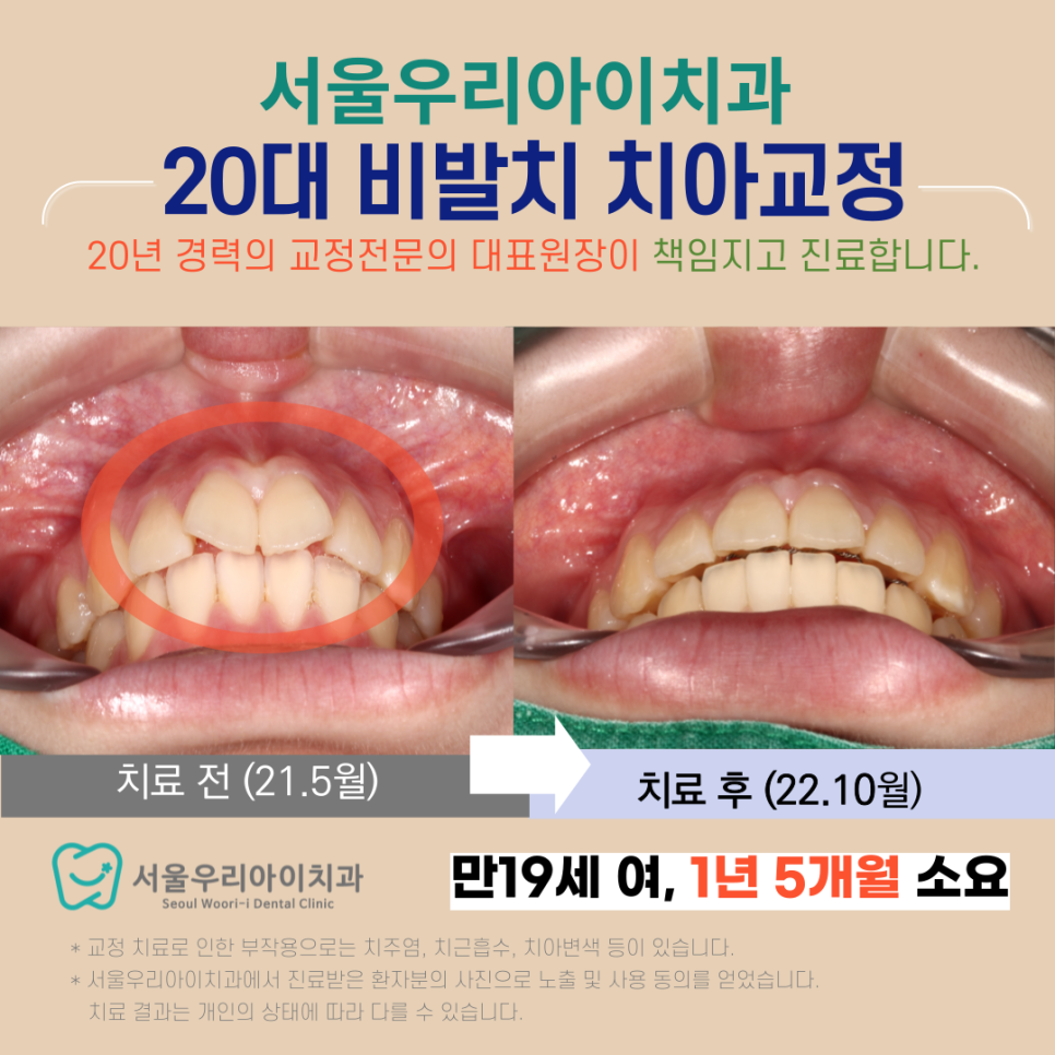 광주 교정치과 삐뚠 치열 튀어나온 앞니 해결하는 방법은?