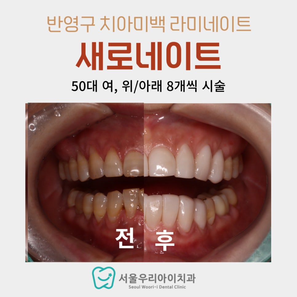 광산구 치아미백 치과에서 반영구 치아미백으로 50대 여성의 치아...
