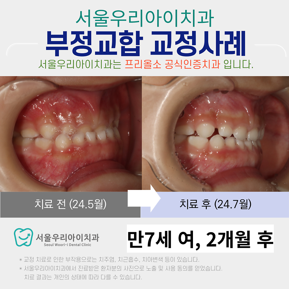 프리올소 교정장치란? 프리올소는 어떤 상황에 사용할까요?