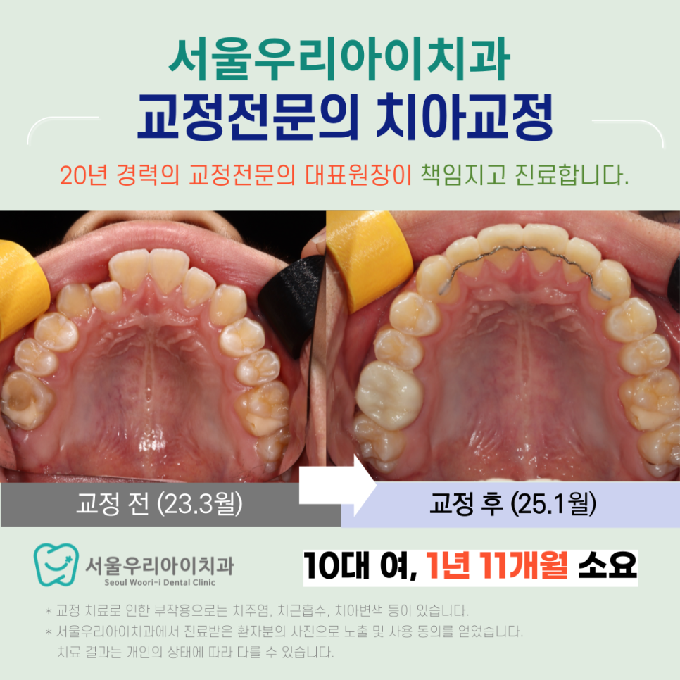 20년 이상 경험많은 교정전문의가 직접 진료하는 광주교정치과는?