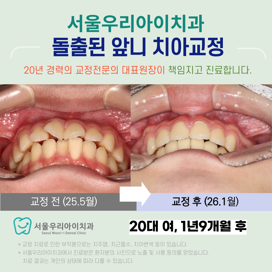광주 부분교정 치열이 삐뚤어서 스트레스라면 교정전문의에게