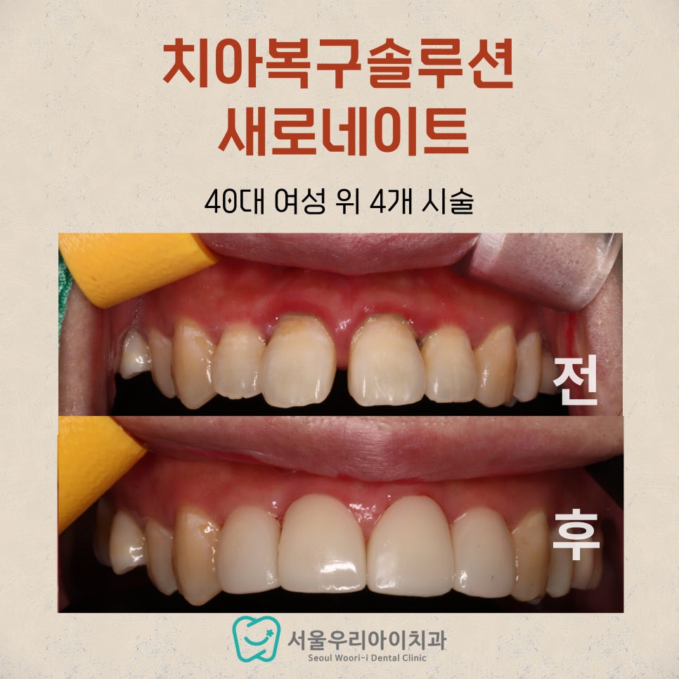 광주에서 앞니 치료에 진심인 치과에서 라미네이트 진료를 통해 아...