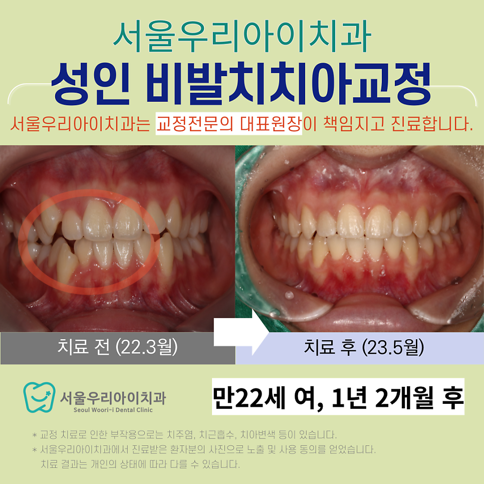 광주광산구교정치과 광주교정전문의 진료가 가능한 교정치과를 찾는다면?