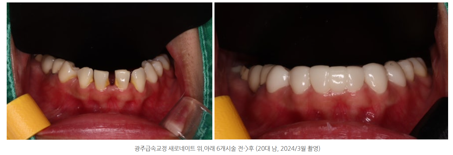광주광역시에서 라미네이트 진료를 가장 잘 하는 치과는 어디일까요?
