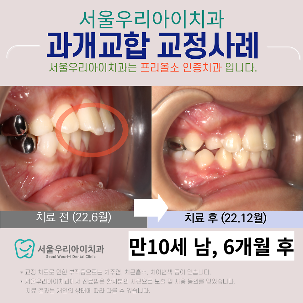 치아교정 광산구 수완지구 교정치과 뻐드러진 이를 교정하는 방법은?