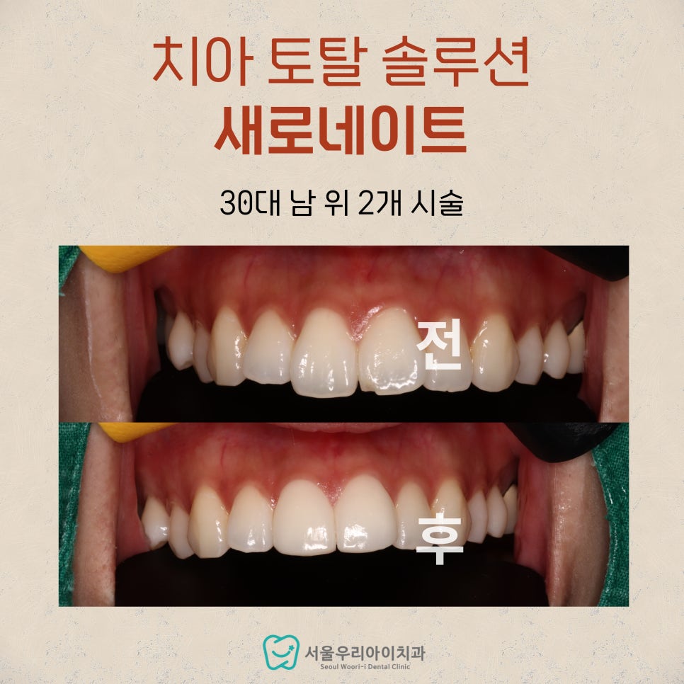 라미네이트 1개 , 2개만 해도 되나요? 광주에서 라미네이트 1...