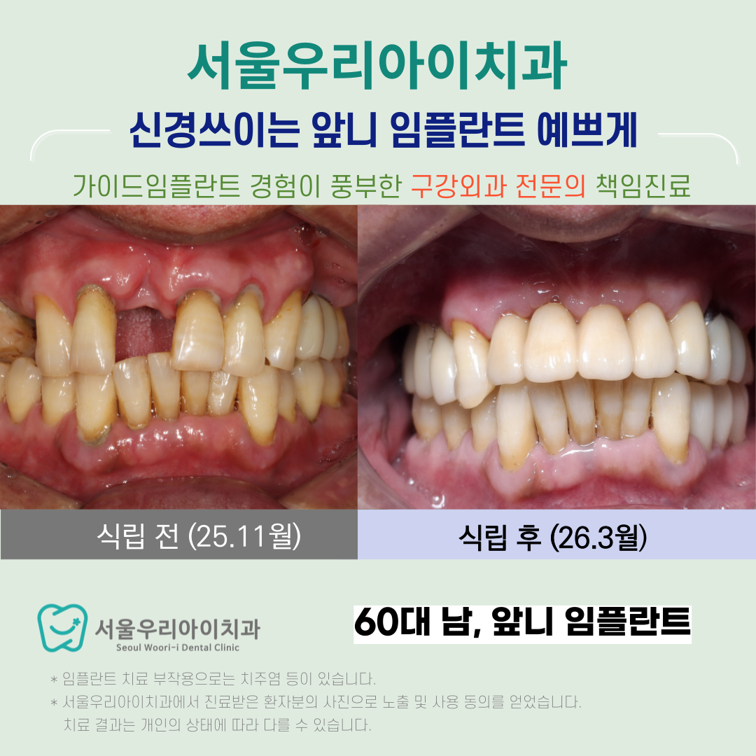 광주 앞니임플란트 신경쓰이는 앞니 임플란트 이제는 예쁘게 잘 씹...