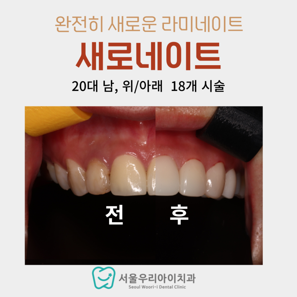 연예인 라미네이트 하는 치과의사 누구? 광주광역시에서 유일하게...