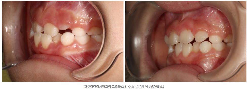 광주 아이교정 청소년교정치과 전문으로 하는 곳이 있나요?