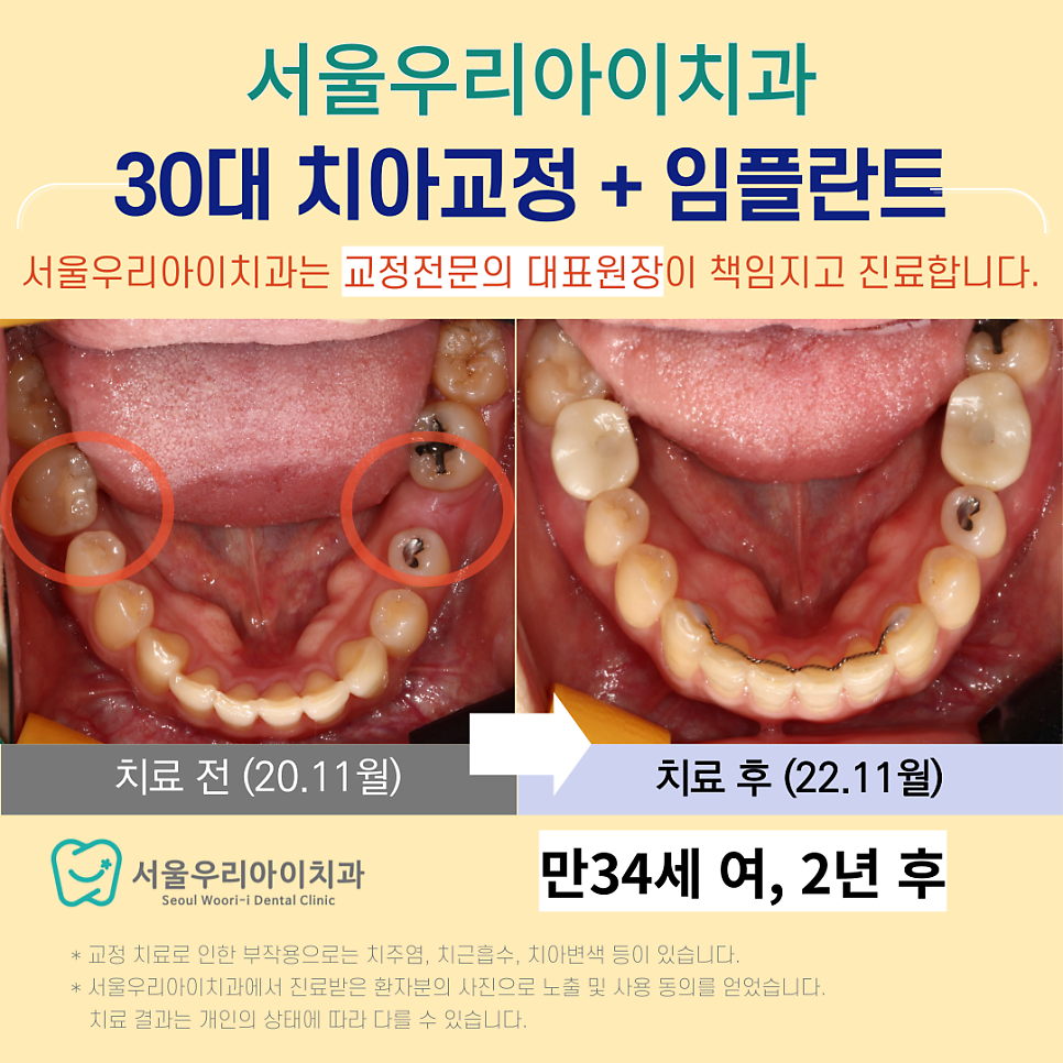 광주 임플란트와 광주 치아교정이 동시에 가능한 광주교정치과