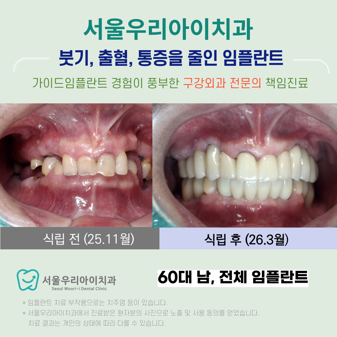수완동 임플란트 가격 말고 정말 따져봐야 하는 항목은 무엇일까요