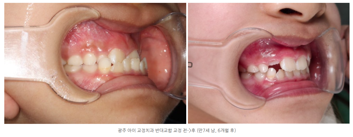 반대교합을 교정하는 방법은 무엇이 있나요?