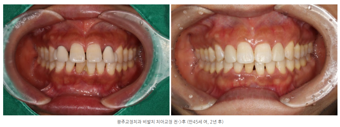 40대에도 치아교정을 시작하나요? 치아교정 나이는 몇 살까지 가...