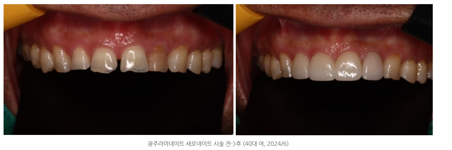 광산구 라미네이트치과 앞니가 벌어져서 고민인 분들 안읽으시면 후...