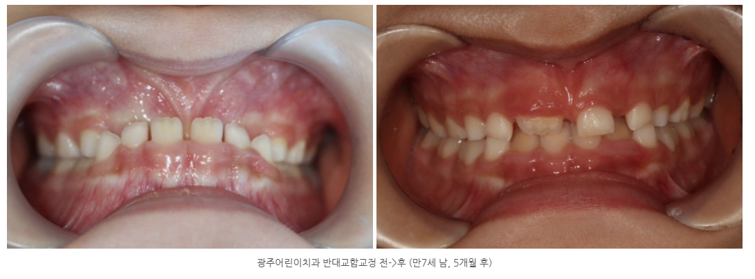 프리올소 반대교합이 심할 때 아이교정치과에서 해결하는 방법은?