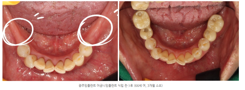 화순 임플란트 치과를 방문하신 치과 공포증이 정말 심한 분의 디...