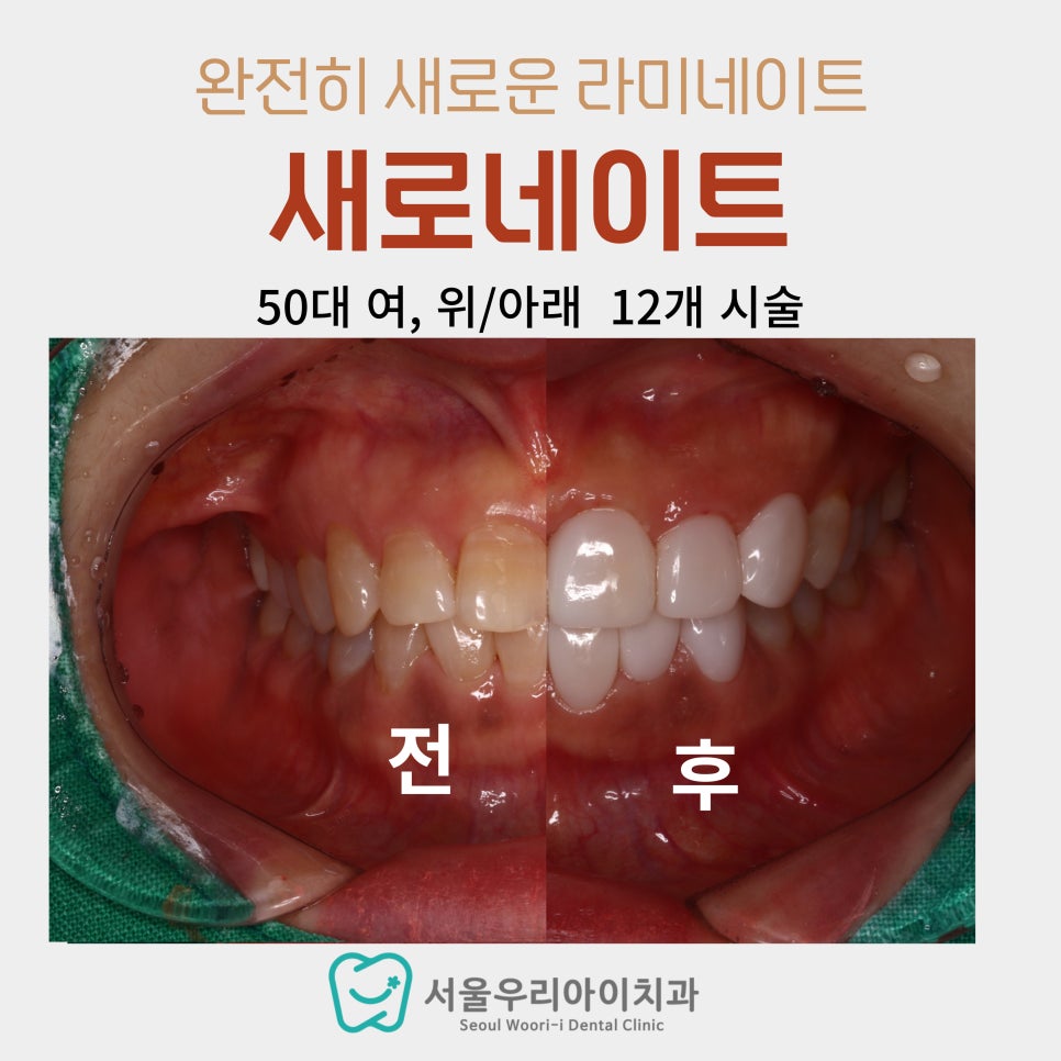 50대도 라미네이트 할 수 있나요? 60대도 라미네이트 할 수...