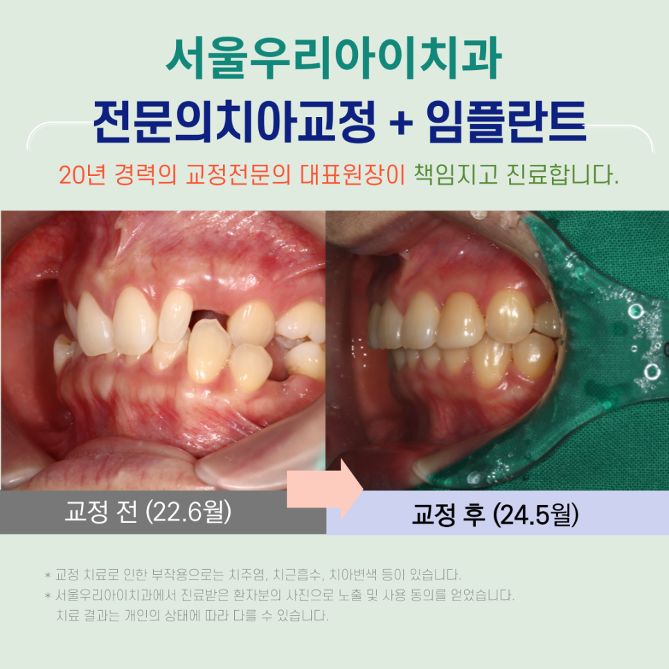 광주광역시에서 치아교정과 임플란트를 한 번에 할 수 있는 교정치과는?
