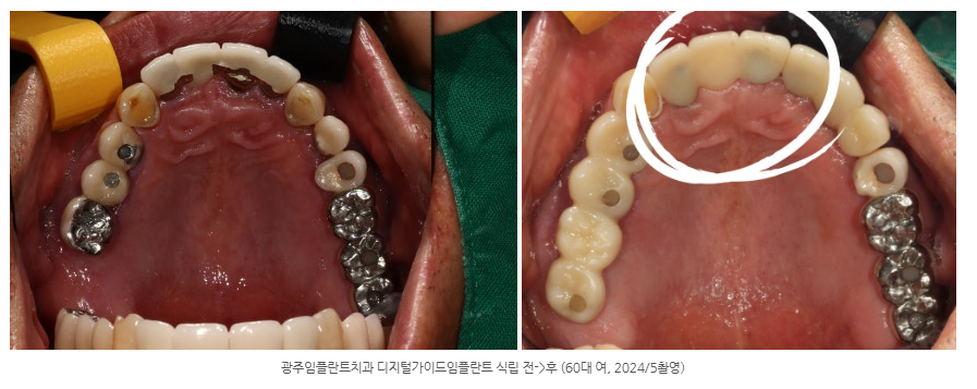 광주광역시에서 뼈가 부족한 사람도 임플란트 가능한 치과가 있나요?
