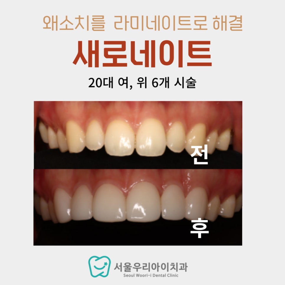 앞니 크기가 다를 때 광산구 라미네이트 치과에서 개선하는 방법이...