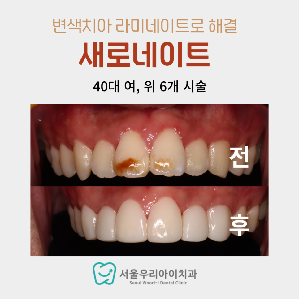 까만 앞니 충치로 까맣게 된 앞니 치료하고 싶어요
