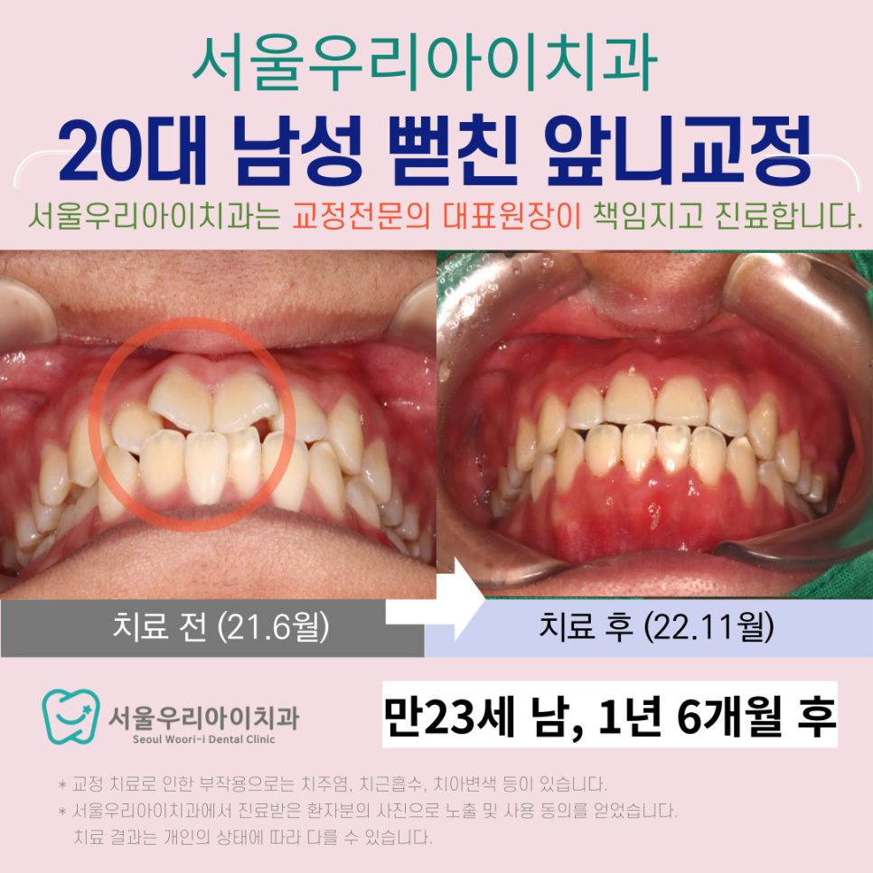 광산구 교정치과 뻗친 앞니를 교정하는 방법은 무엇일까요?