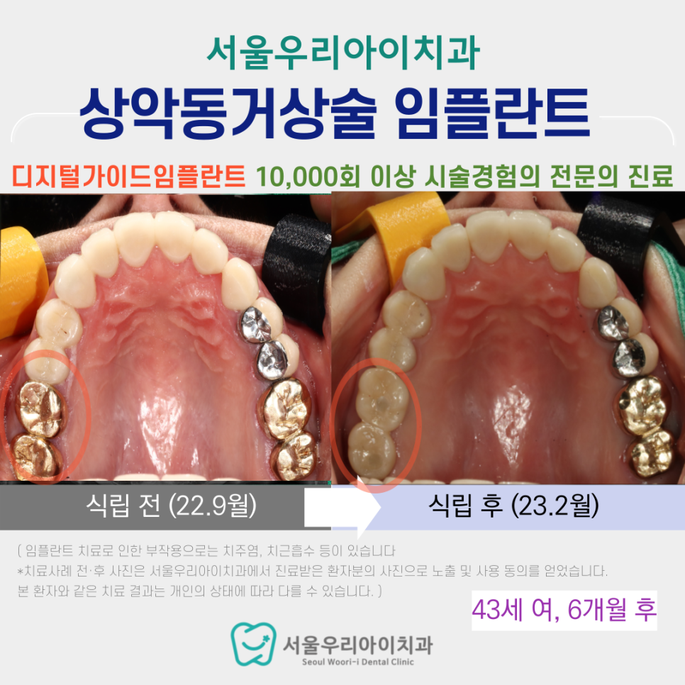 광주광역시에서 상악동거상술을 이용하여 뼈 부족한 임플란트 식립에...
