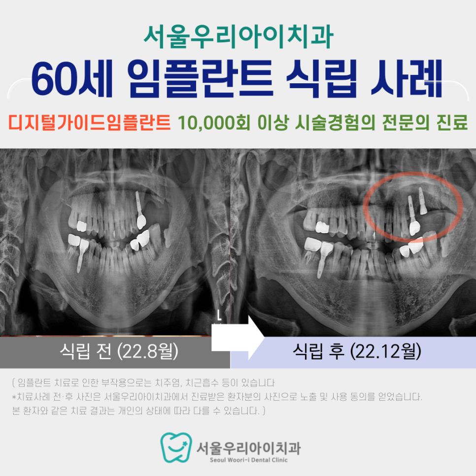다른 치과에서 불가능하다고 했지만 광산구 임플란트 치과에서는 가...