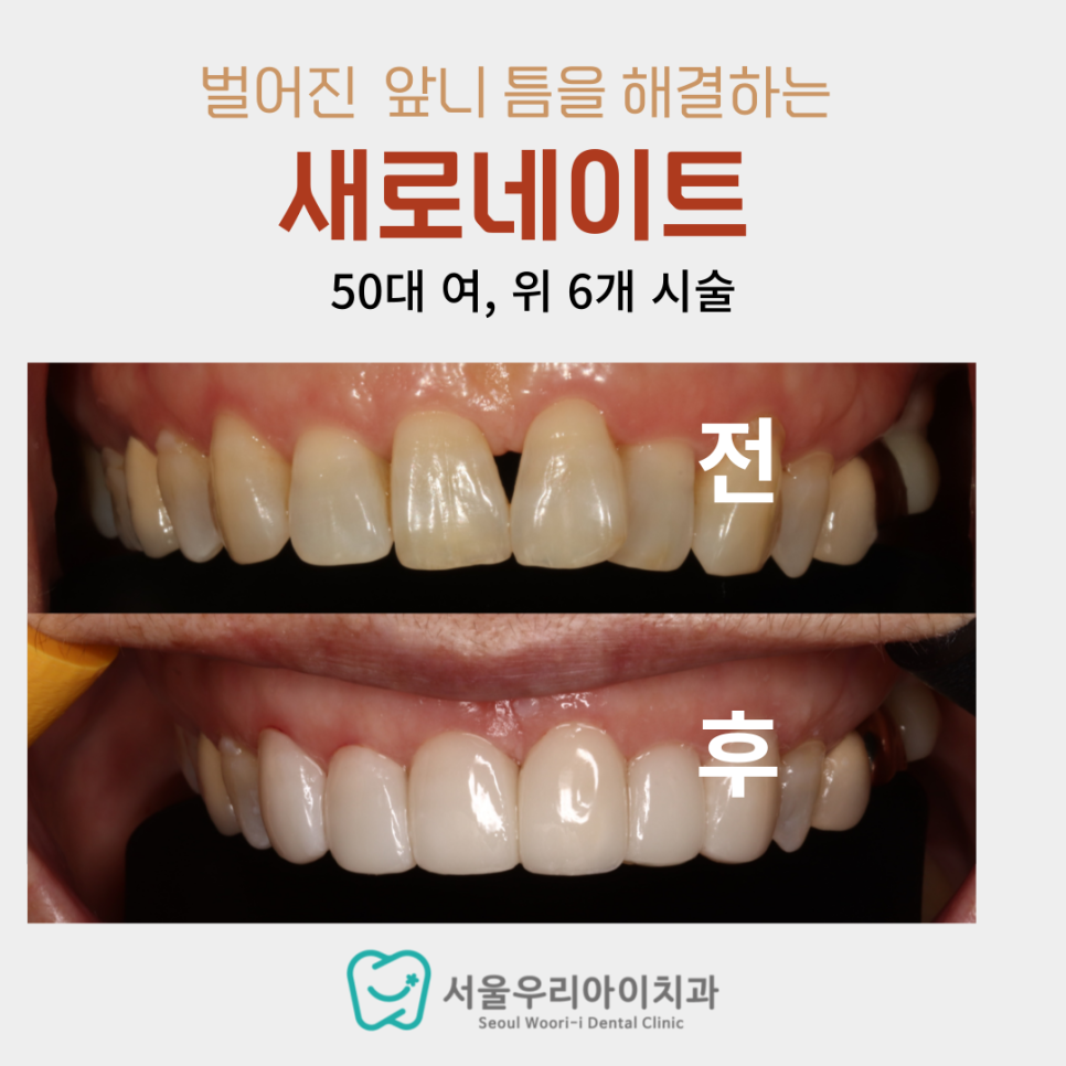광주 60대라면 필독해야할 벌어진 앞니 해결법