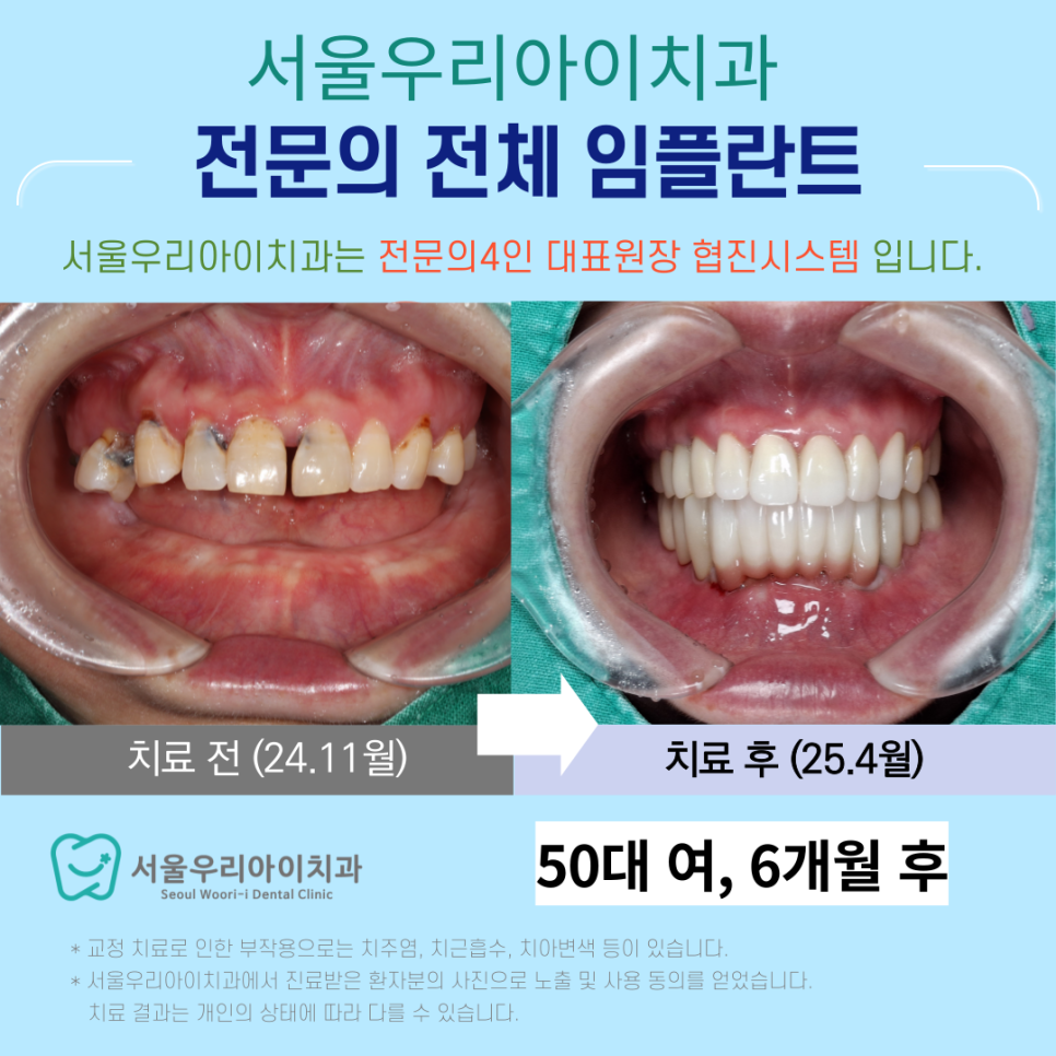 틀니를 오래 사용해도 임플란트 수술이 가능할까요?