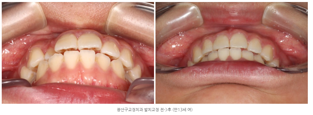 만13세이상이 되면 치열교정을 시작할 수 있나요? 발치교정 사례