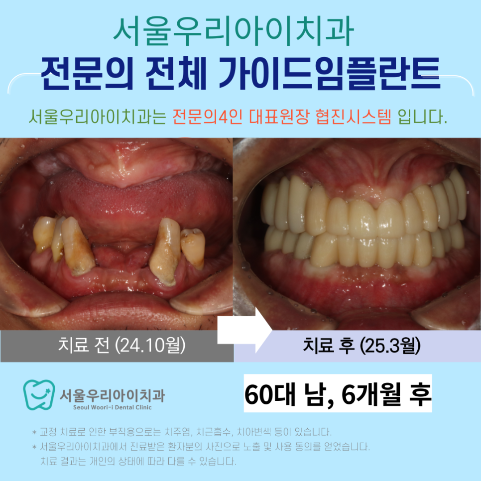 광산구 임플란트치과에서 가이드 임플란트 수술로 성공적인 임플란트
