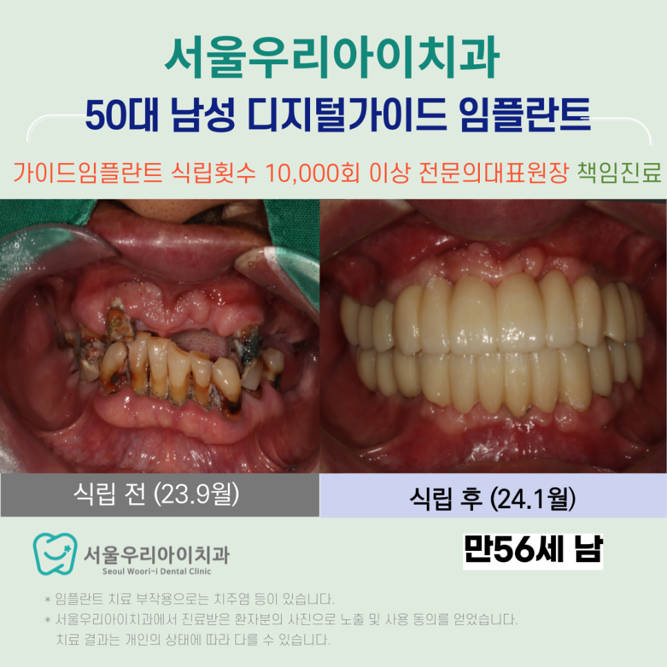 광산구 전문의가 직접 진료하는 임플란트 치과에서 진료받으세요