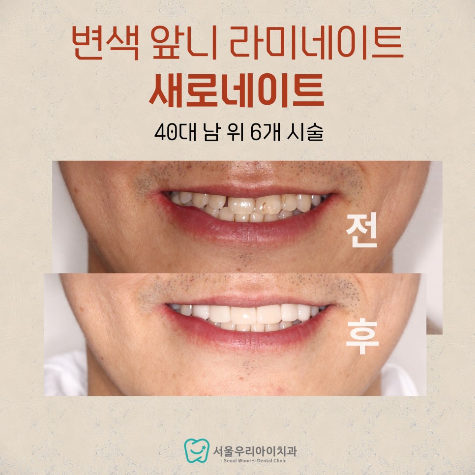 광주에서 흡연하는 40대 이상 남성분의 치아변색을 해결하는 치료법은?