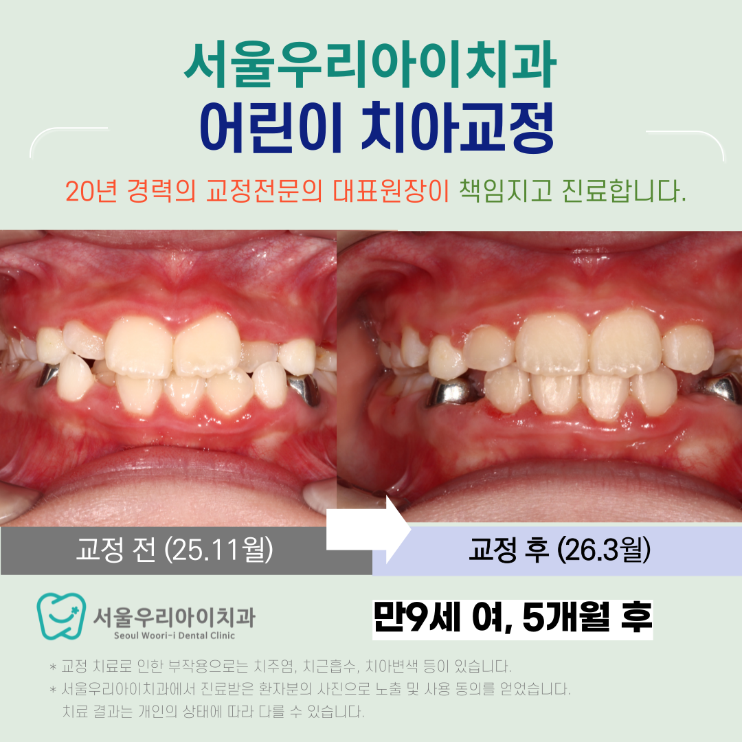 광주 어린이교정치과에서 차교정으로 개월만에 완성하는 고른 치열은
