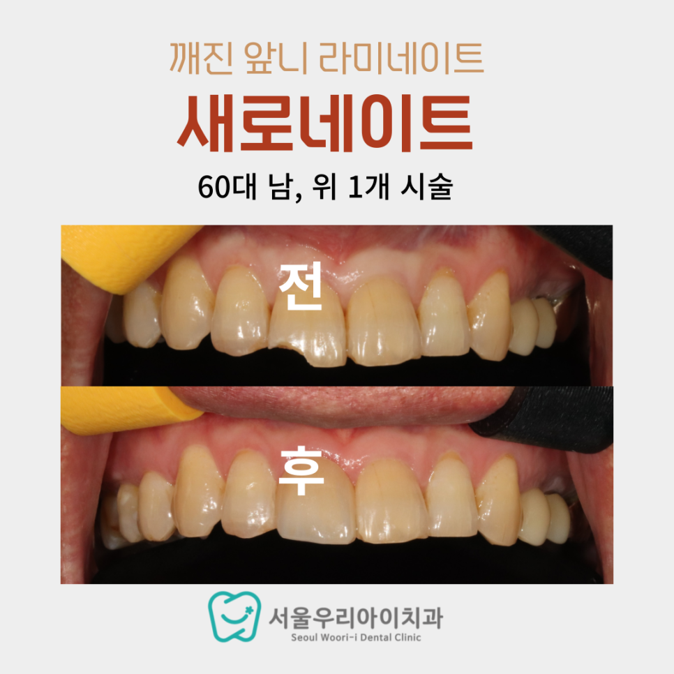 광주에서 앞니가 깨졌다면 치료방법은 무엇인가요?