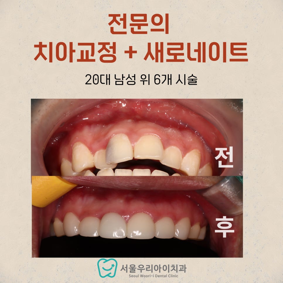 30대, 40대 남자 연예인들이 했다는 앞니 라미네이트 효과는...