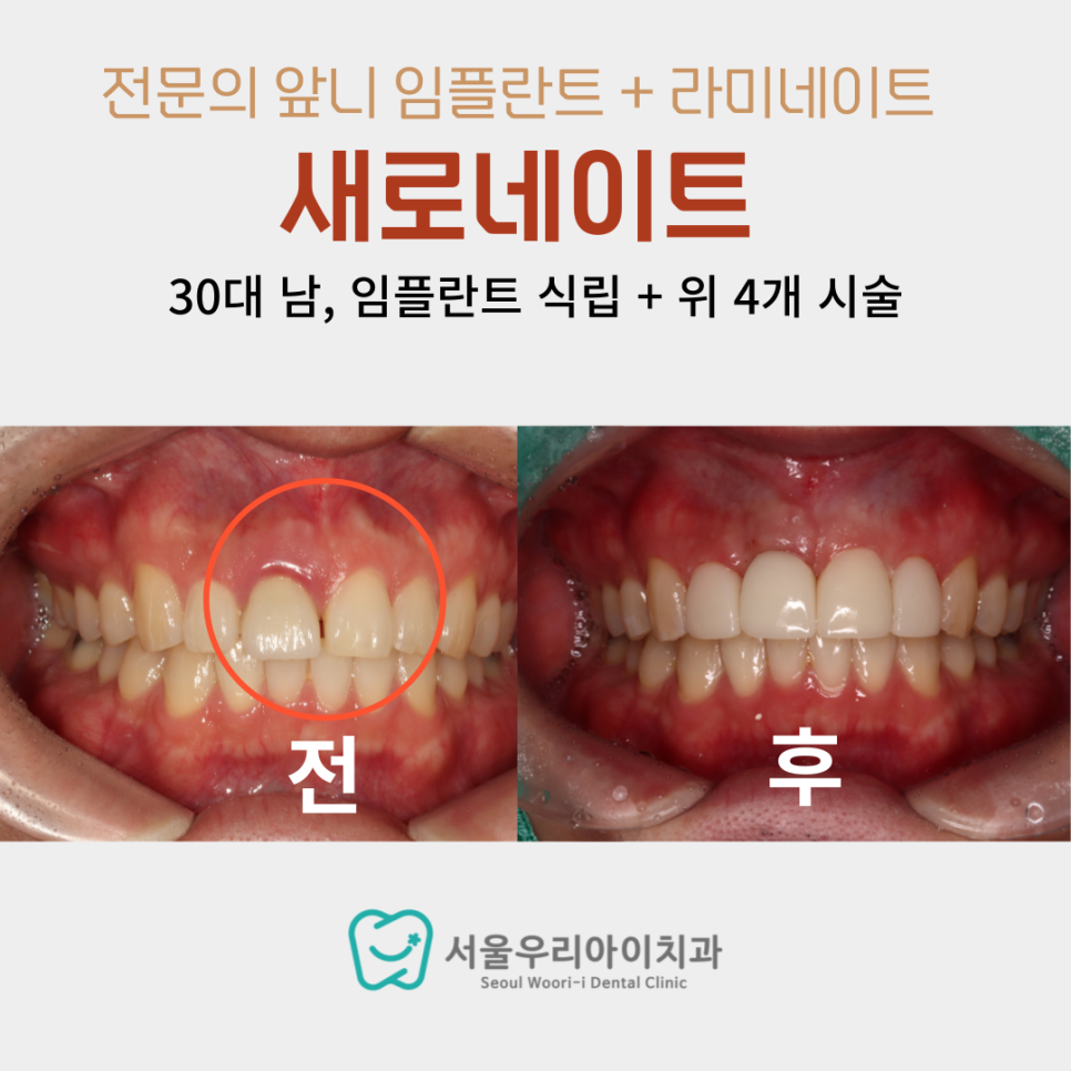 광주광역시 임플란트와 라미네이트를 동시에 진료하면 어떻게 될까요?