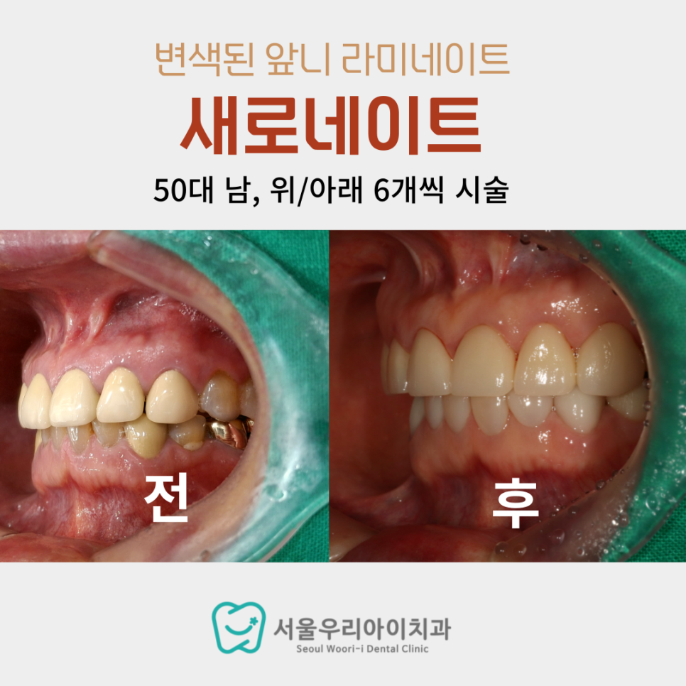 60대 남자도 광주에서 라미네이트가 가능한가요?