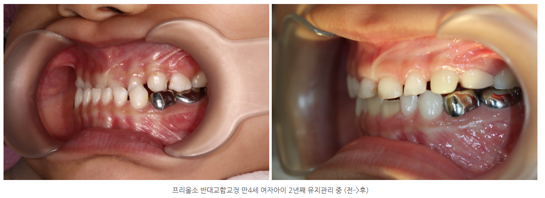 광주 아이교정치과 프리올소 반대교합 만4세, 만5세 케이스