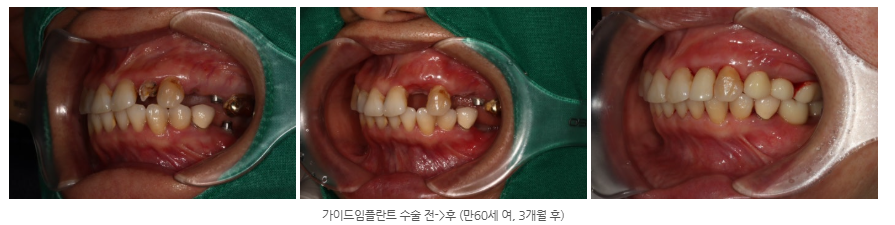 수완지구에서 다른 치과에서 계속 실패했던 임플란트 수술을 성공적...