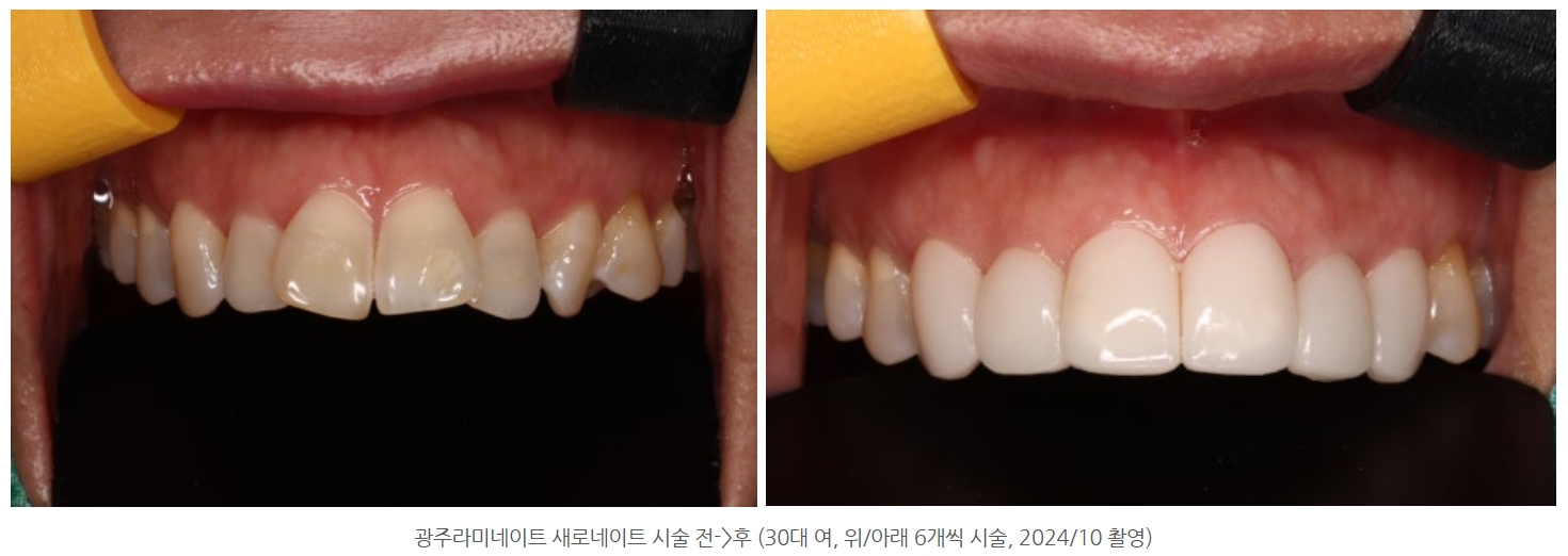 광주 앞니 라미네이트 잘하는 치과 우리치과