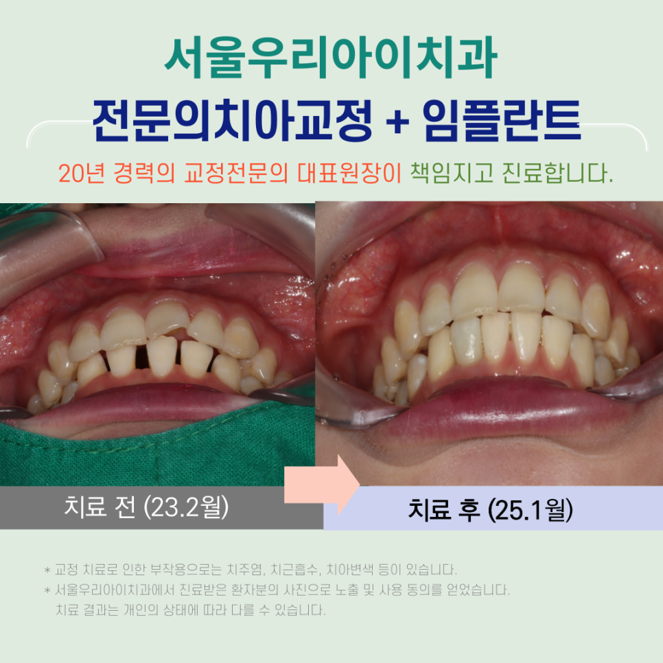 치아교정과 임플란트를 같이 동시에 할 수 있을까요?