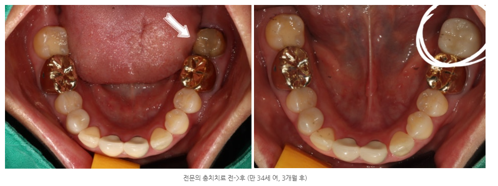 수완동 임플란트 붓고 흔들리는 치아에는 가이드 임플란트 방법으로...
