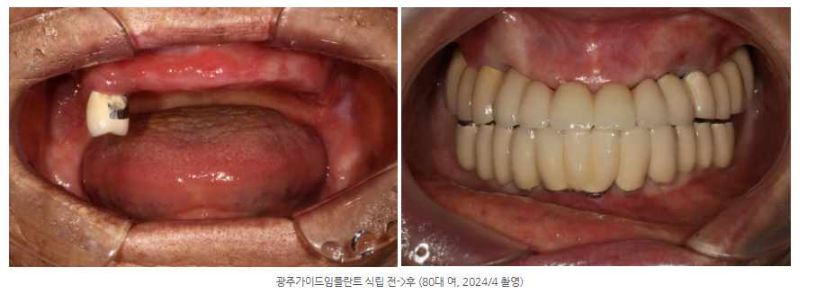 다른 치과에서 틀니 추천했는데 광주 임플란트 가능한 치과가 있나요?