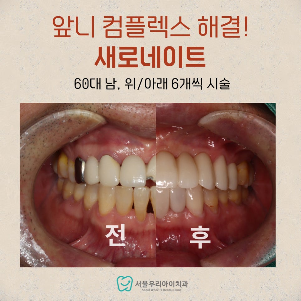 중년 50대 이상 라미네이트는 의미없는 정보, 광고성 블로그 아...