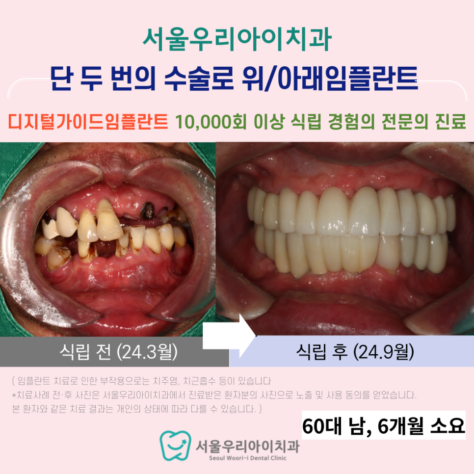광주에서 전체 임플란트를 잘하는 치과를 찾는다면?